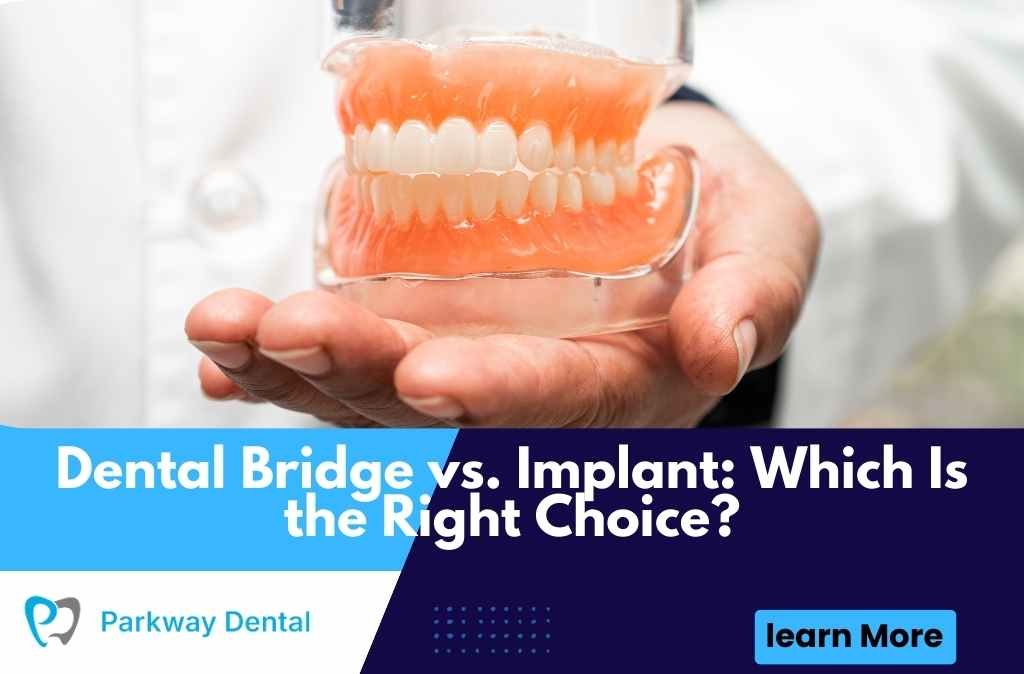 Dental Bridge vs. Implant: Which Is the Right Choice?