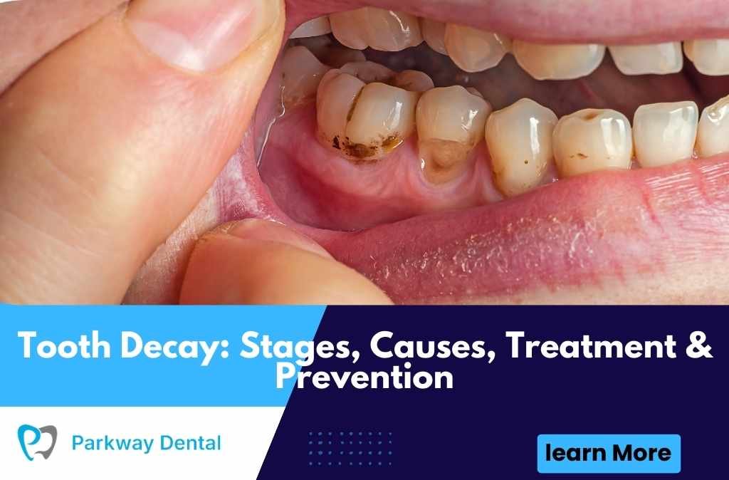 Tooth Decay: Stages, Causes, Treatment & Prevention