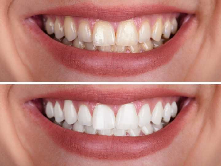 Who Should Get Teeth Whitening at the Dentist