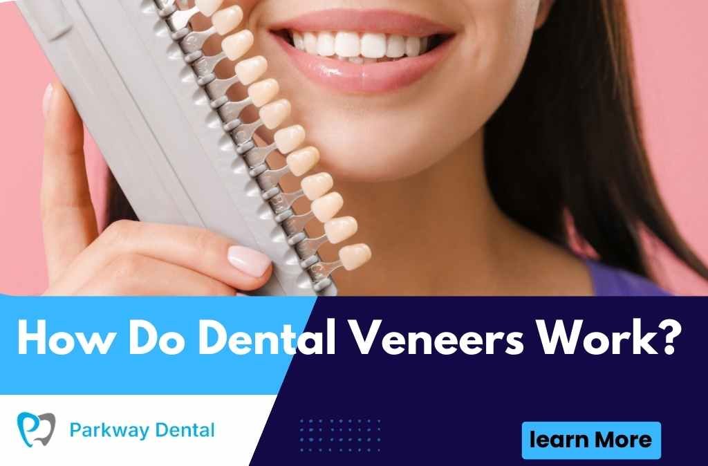 How Do Dental Veneers Work?