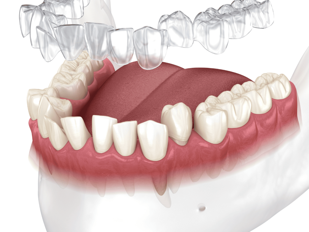 invisalign west roxbury