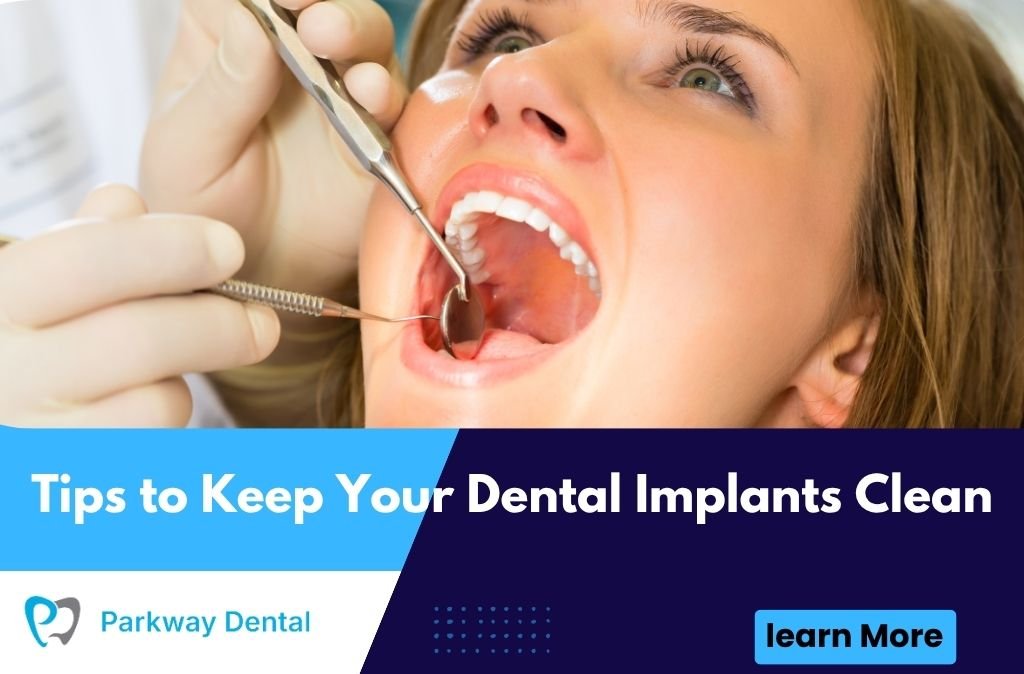 Tips to Keep Your Dental Implants Clean