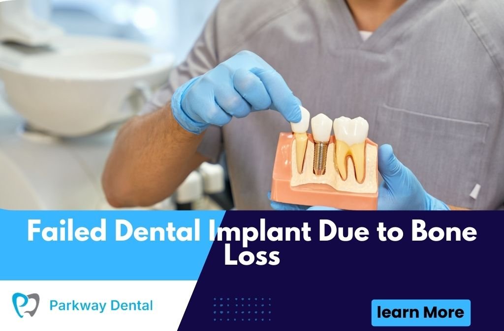 Failed Dental Implant Due to Bone Loss