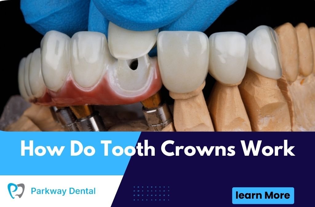How Do Tooth Crowns Work
