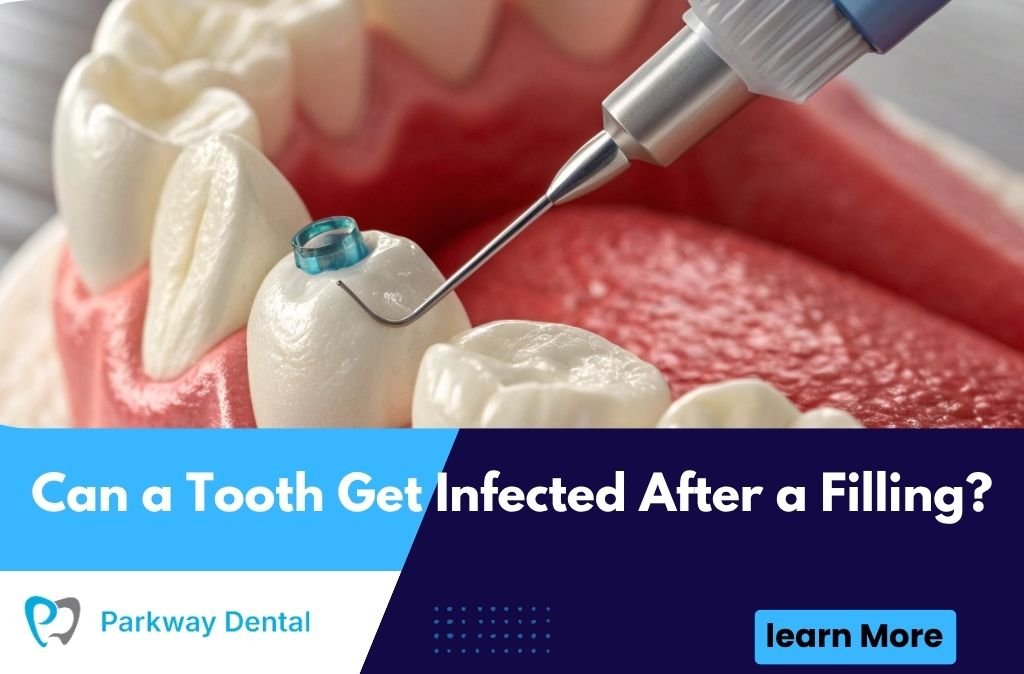 Can a Tooth Get Infected After a Filling?