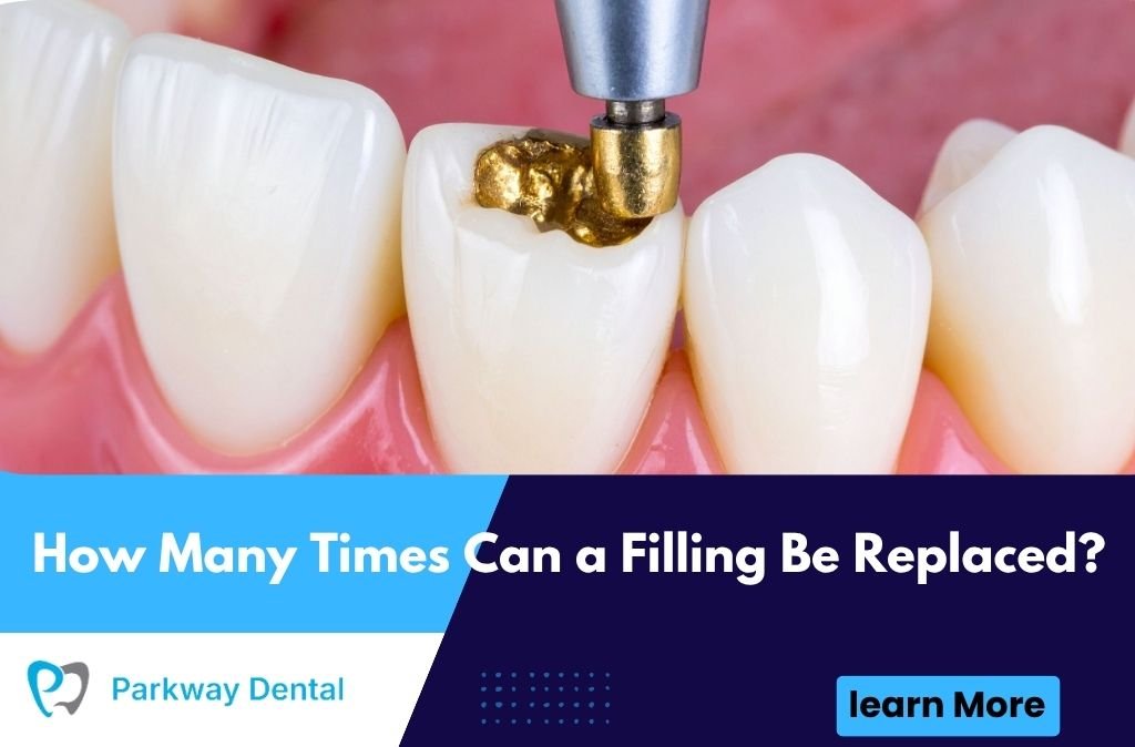 How Many Times Can a Filling Be Replaced?