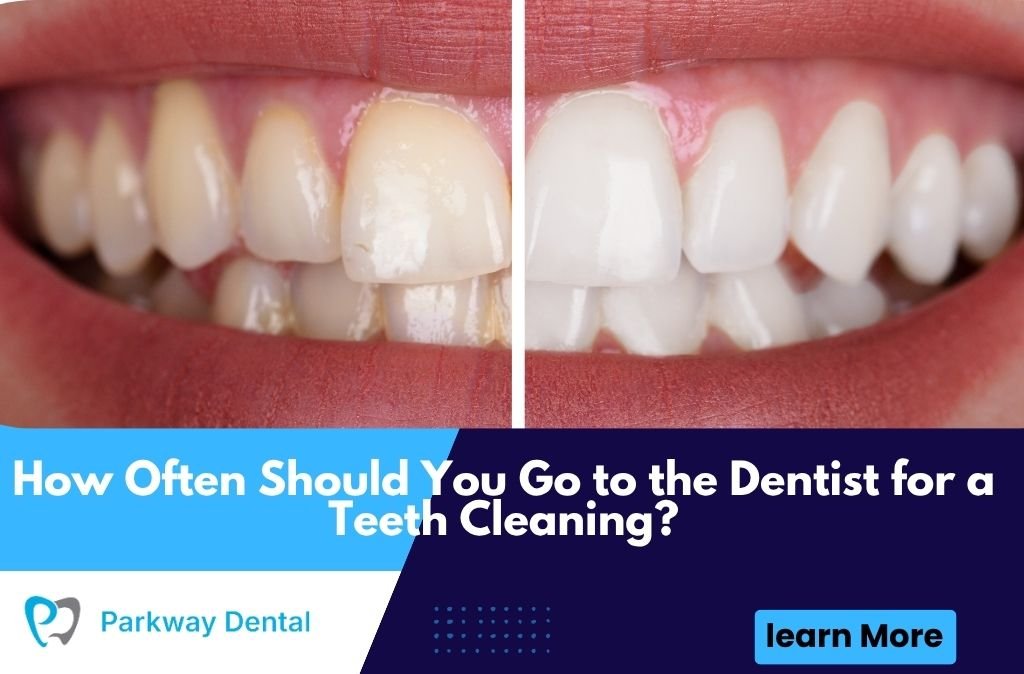 How Often Should You Go to the Dentist for a Teeth Cleaning?