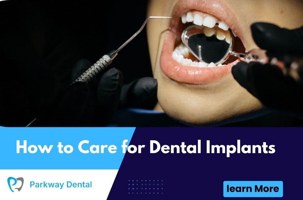 How to Care for Dental Implants