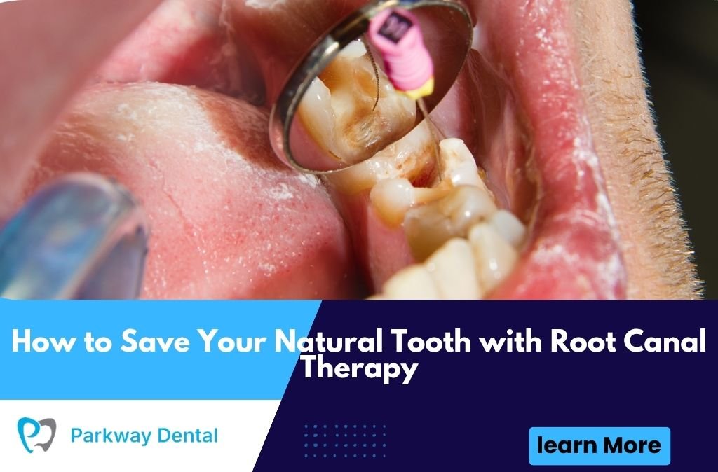 How to Save Your Natural Tooth with Root Canal Therapy