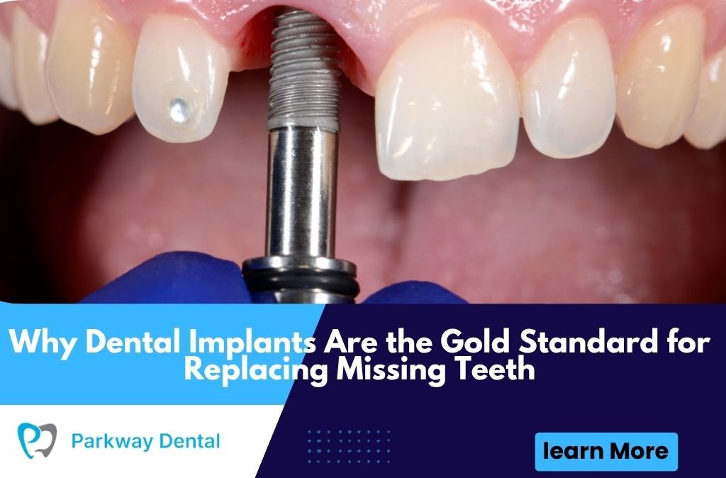 Why Dental Implants Are the Gold Standard for Replacing Missing Teeth