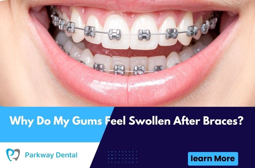 Why Do My Gums Feel Swollen After Braces?