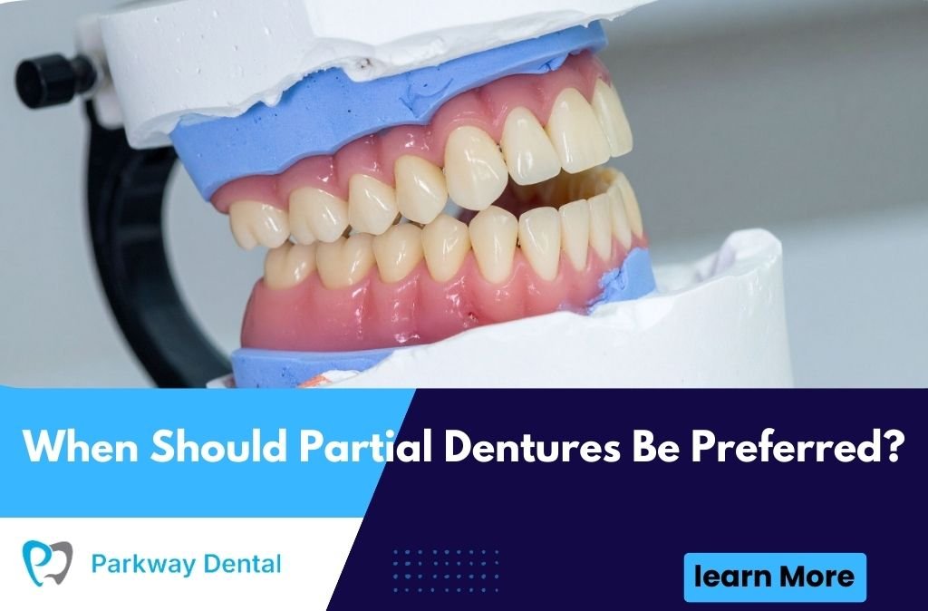 When Should Partial Dentures Be Preferred