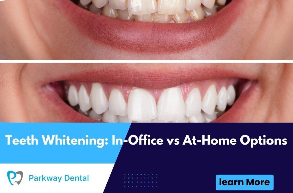 Teeth Whitening: In-Office vs At-Home Options