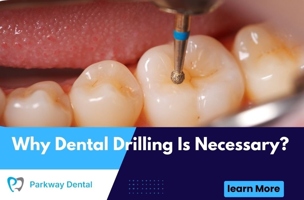 Why Dental Drilling Is Necessary